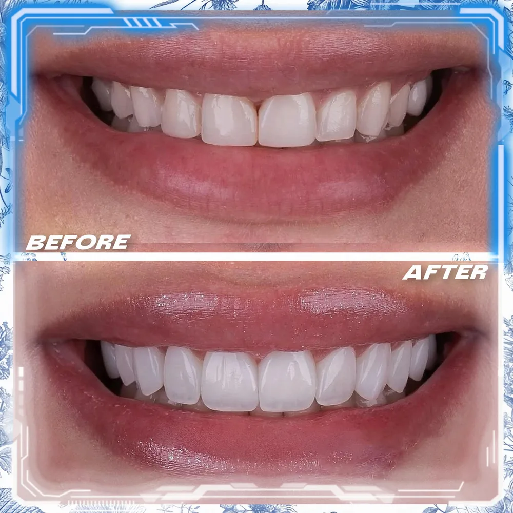 Case 02: a smile transformed at Cronos Dental